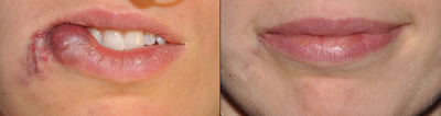 Lip Surgery to Remove Vascular Malformation and Create Symmetric Lip - After removal of a blood vessel malformation of the right side of her mouth, this 32 year old woman had a full-thickness defect of her lip. Her lip and corner of her mouth (oral commissure) were repaired by advancing the remaining lower lip into the defect. She is shown 5 months post-operative.