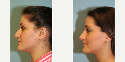 25-34 year old woman treated with Rhinoplasty - Rhinoplasty