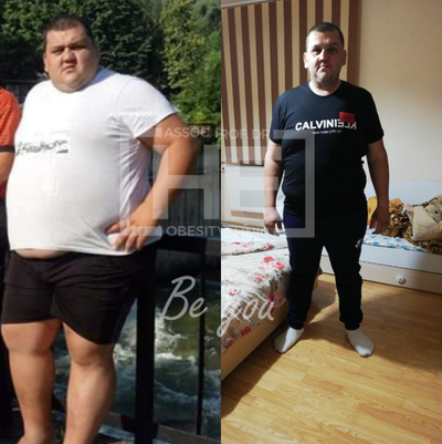 45-54 year old man treated with Gastric Bypass - Lost 75 kg in 11 months.We are proud of him.