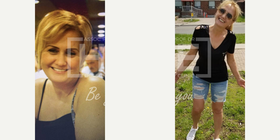 35-44 year old woman treated with Gastric Bypass - Lost 40 kgWe are proud of her.