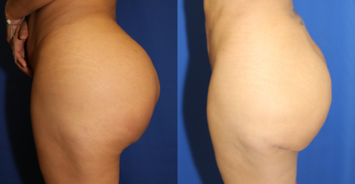 25-34 year old woman treated with Silicone Injection Removal - This patient had raw silicone injected into her buttocks. The raw silicone injections caused her pain, redness of the skin and buttocks droopiness.