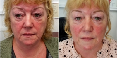 55-64 year old woman treated with Silhouette Soft - 4 threads of silhouette soft, 1 area of Botox and 2 ml of cheek fillers