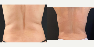 45-54 year old woman treated with Breast Reconstruction Revision - This patient had previous implant-based breast reconstruction after breast cancer and was unhappy with her breast contour. She was particularly concerned with the divot above the left breast implant. She elected to undergo fat transfer to add natural- volume and a softer looking aesthetic result. Here are her results after one round of fat transfer. She plans to undergo addition fat transfer to further build natural volume to improve contour in this area. Fat transfer was performed by re-purposing stubborn fat from the waist area. This fat was removed using liposuction techniques and added over top of the previous breast reconstruction.