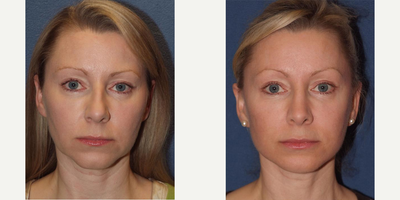 Revisional Facelift  - Revisional Facelift procedure