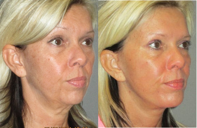 45-54 year old woman treated with Mini Lift - This young lady presented to our Center with early signs of jowling and loss of her jawline definition. In addition, she stated that her neck and area under her chin was starting to droop. We recommended and performed a mini lower facelift to re-establish her jawline and tighten the skin and muscles of the lower face and upper neck. This procedure was performed comfortably in our Center using only local anesthesia and mild oral sedation with valium. All of her sutures were removed in one week, and she was allowed at that time to resume normal activity.