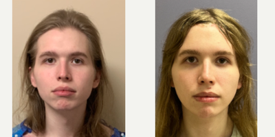 18-24 year old woman treated with Brow Lift, Forehead Reduction, Transgender Facial Feminization Surgery, Facial Feminization Su - this is a young lady who underwent facial surgery: forehead reconstruction, septorhinoplasty, jaw/mandible reduction.