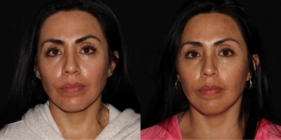 45-54 year old woman treated with Sofwave - This patient was treated with one session of Sofwave in the Upper Face region. She is 3 months post-procedure and is seeing great results so far. Client plans to do another session to target the Lower Face and Neck.