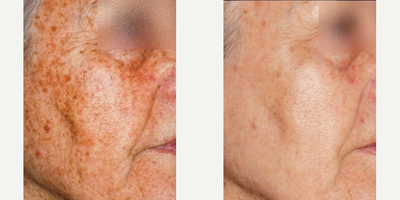 Woman treated with IPL - iplTreat sun damage, full skin, wrinkles, texture irregularities and more with IPL treatments.Intense Pulsed Light (IPL) therapy uses short blasts of high-intensity light to produce younger looking skin, with NO downtime.