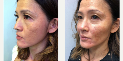 45-54 year old woman treated with Voluma - The patient is a 45-55 year old female treated with Voluma injections to the lips, collumella of the nose, and cheeks.