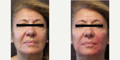 55-64 year old woman treated with Liquid Facelift, Juvederm, Voluma, Vollure, Radiesse, Bellafill - Non-surgical chin augmentation & nose job (liquid rhinoplasty) to sculpt the chin and nose with fillers (Voluma, Radiesse or Bellafill)