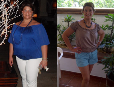 female treated with sleeve gastrectomy - female  ,  treated  with a  sleeve gastrectomy. she had 245 pounds at the time of surgery, with   obesity associated diseasses  . this it is  she  one years after  surgery. she  weighs 155 pounds  (down  90 pounds).