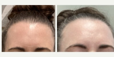 45-54 year old woman treated with Microneedling RF, Scar Removal - Case Overview: This patient sought treatment for moderate textural scarring and atrophic acne scars on the face. A series of Microneedling RF sessions was designed to stimulate neocollagenesis and elastin production deep within the dermal matrix without requiring aggressive downtime or traditional laser ablation.Mechanism & Clinical Notes: By utilizing fine microneedles to deliver fractionated radiofrequency energy directly into the dermis, the treatment triggers the bodys natural wound-healing cascade. This breaks down fibrotic scar tissue while encouraging uniform collagen remodeling.Outcome: Noticeable improvement in skin texture, softer scar margins, and enhanced dermal density, resulting in a smoother, more even complexion over the treatment course.