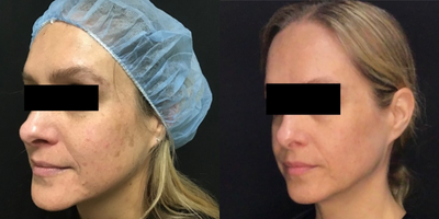 35-44 year old woman treated with GentleLase - This patient has sun-damaged skin and was treated with an alexandrite laser for her brown spots with great results.