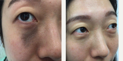 35-44 year old woman treated with PicoSure - Nevus of Ota birthmark was initially treated with two ruby lasers and no improvement. After 6th and last PicoPlus laser the Nevus of Ota birthmark is close to 100% eradicated