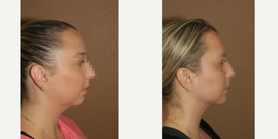 25-34 year old woman treated with Chin Implant - Chin augmentation and liposuction of the neck