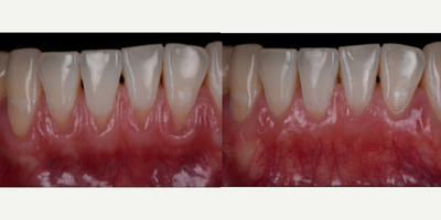 35-44 year old man treated with Root Coverage Procedures  - This patient reported sensitivity to cold foods. His lower teeth were very long and the gum line was receded. Gum grafting was performed to achieve a correct tooth size and proportion along with natural looking soft tissue.&nbsp;