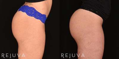 Before and 1 Year After Non-Surgical Butt Lift with Sculptra Aesthetic - Before and 1 Year After Non-Surgical Butt Lift with Sculptra Aesthetic