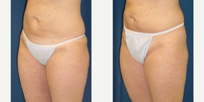 Woman treated with Thigh Lift - Woman treated with Thigh Lift