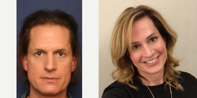 MTF Facial Feminization Surgery - Before and After