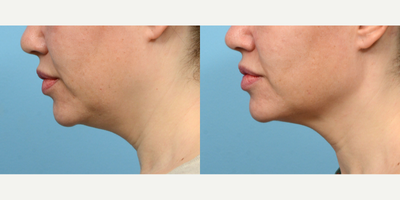 35-44 year old woman treated with CoolMini, CoolSculpting - Looking to permanently remove fat from underneath her chin, this patient came to Wise Med Spa for CoolMini. 2 months after her treatment she loves her side profile.