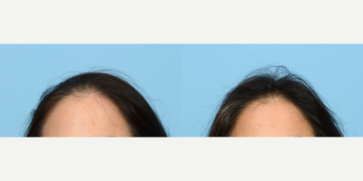 45-54 year old woman treated with PRP Injections, PRP for Hair Loss - To renew the thickness of her hair, this 48-year-old patient underwent 3 sessions of PRP therapy with Dr. Wise. Her results are shown 3 months after her latest treatment.