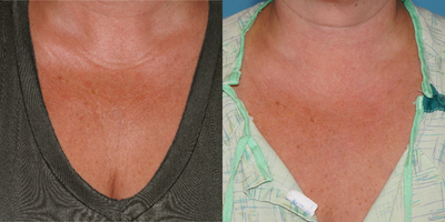 35-44 year old woman treated with Sculptra to help with the fine lines of the chest - Patient presented with fine lines and wrinkling of her chest secondary to extensive sun exposure while younger. Treated with 2 treatments of diluted sculptra, 1 month apart. Results continue to improve as the skin texture and dcolletage improve in appearance with simple procedure and minimal downtime.