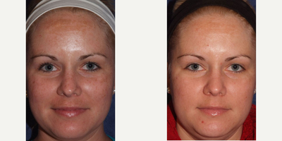 Spectra Laser for Sun Spots Patient 1 - Spectra Laser procedure for sun spots.