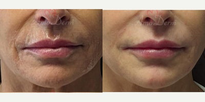 55-64 year old woman treated with Juvederm, Vollure - Treatment of nasolabial folds (laugh lines) and marionette lines with Juvederm, Radiesse, Vollure, Restylane or Bellafill injected with cannula