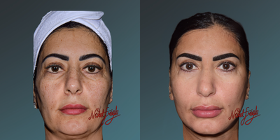 35-44 year old woman treated with Fraxel Laser - 35-44 year old woman treated with Fraxel Laser