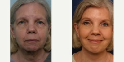 Woman treated with Cheek Lift - Woman treated with Cheek Lift