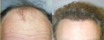 NeoGraft - NeoGraft