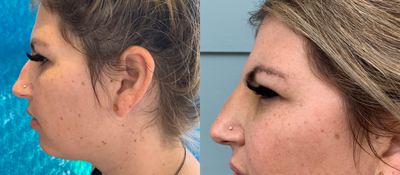 25-34 year old woman treated with Nonsurgical Nose Job - Threads - This patient wanted to decrease the bump on her nose, refine her tip and rotate her tip slightly upwards. With one Eurothread, her bump is gone. Minimal pain, swelling, and bruising.