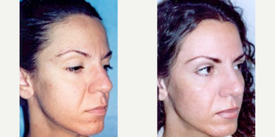 Woman treated with Cheek Lift - Woman treated with Cheek Lift and Thread Lift
