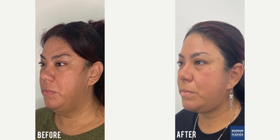 45-54 year old woman treated with Facelift - Deep Plane Facelift under local anesthesia