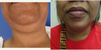 45-54 year old woman treated with FaceTite - Facetite of chin and neck
