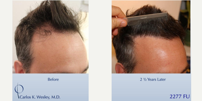 #BAM Most Natural Hairline (2277 FUE and FUT grafts): Carlos K. Wesley, M.D. (NYC&LA) - In order to repair a poorly-executed transplant performed by another surgeon, this 39-year-old man underwent a session combining follicular unit extraction (FUE) with follicular unit transplantation (FUT) with Dr. Carlos K. Wesley in which a total of 2277 grafts were placedAspects of our surgical approach can be viewed on our sites Most Common Questions page. Three unique elements combined to help improve his experience: no-shave requirement for optimal discretion, enhanced graft storage measures, and rigid patient safety standards.As with all of Dr. Wesleys patients, he was NOT required to cut his hair for the procedure. As a result, this patient was able to return comfortably to work and social activities within approximately 7-10 days of his procedure.The patients hair follicles were incubated in platelet rich plasma (PRP) throughout the duration of the procedure. This, combined with an ATP-containing storage solution has been shown to enhance survival of transplanted hairs.The patient returned 2.5 years after his procedure and images of the patient can be seen below.