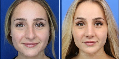 Woman treated with Rhinoplasty - Woman treated with Rhinoplasty