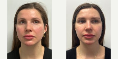 35-44 year old woman treated with MACS Facelift - 37-year-old female before and just seven weeks after MACS Mini Facelift with liposuction of the neck and jawline. Shes still a bit swollen along her jaw, but she and I are pleased with the early result!
