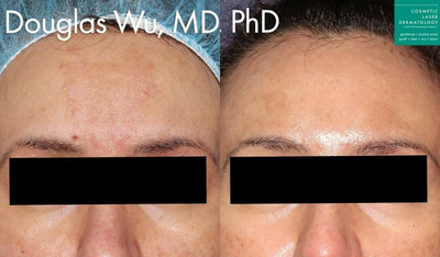 Woman treated with Clear and Brilliant - Picoway, Clear+Brilliant, Vbeam lasers used to treat melasma on the forehead.