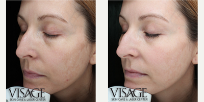 35-44 year old woman treated with SkinCeuticals - Skinceuticals Advanced Corrective Peel & Discoloration Defense Skin Care ProductVisage Skin Care & Laser Center, a division of Robinson Facial Plastic Surgery