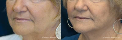 Lower Face Lift - 65-74 year old woman treated with Lower Face Lift