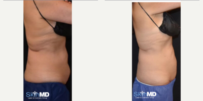 Woman treated with Liposuction - Woman treated with Liposuction