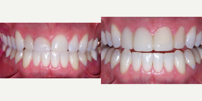 55-64 year old woman treated with Dental Crown - Dental Crowns on 55-64 year old female.