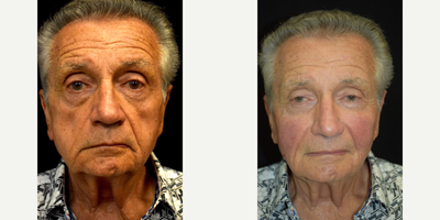 77-year-old man treated with Bellafill - None