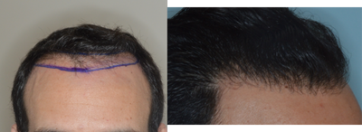 35-44 year old man treated with FUE Hair Transplant - Before and 1 year results after 1100 grafts by FUE to restore the hairline in a 35 year old male. Challenging case in both the creation of natural-appearing results and density. Given the contrast between the dark hair and the light scalp, the creation of density is difficult while the thick, dark hair also creates a challenge in providing for natural-appearing results. The use of finer hairs at the hairline as well as a staggering technique allows for the creation of a natural hairline in this case, while the use of the larger grafts contributes to the density behind the hairline.