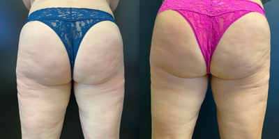 48 year old woman treated with Cellulite treated with Emtone - Final results take 8-12 weeks. This photo was taken at 4th treatment.