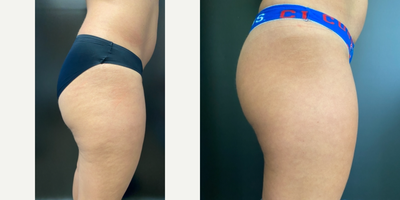 42 year old woman's back of Thighs treated with Emtone - Reduction of cellulite and skin toning with Emtone. Final results 6-8 more weeks.