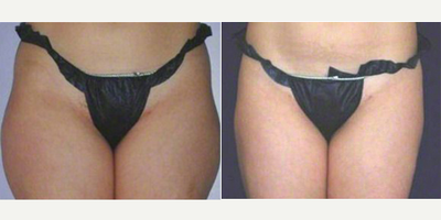 Woman treated with UltraShape - Woman treated with UltraShape