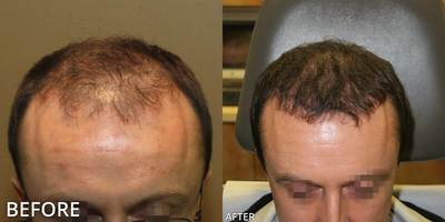 Man treated with ARTAS Robotic Hair Transplant, Hair Transplant - Man treated with Hair Transplant, ARTAS Robotic Hair Transplant