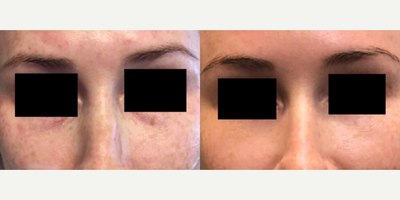 Woman treated with Dermal Fillers - Woman treated with Dermal Fillers using hyaluronic-acid fillers to fill and correct hollows. Pre-op, patient was concerned with her dark and hollowing under eyes.